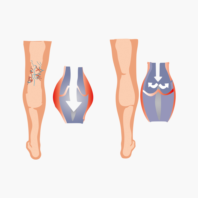 Venex Öncesi Sonrası